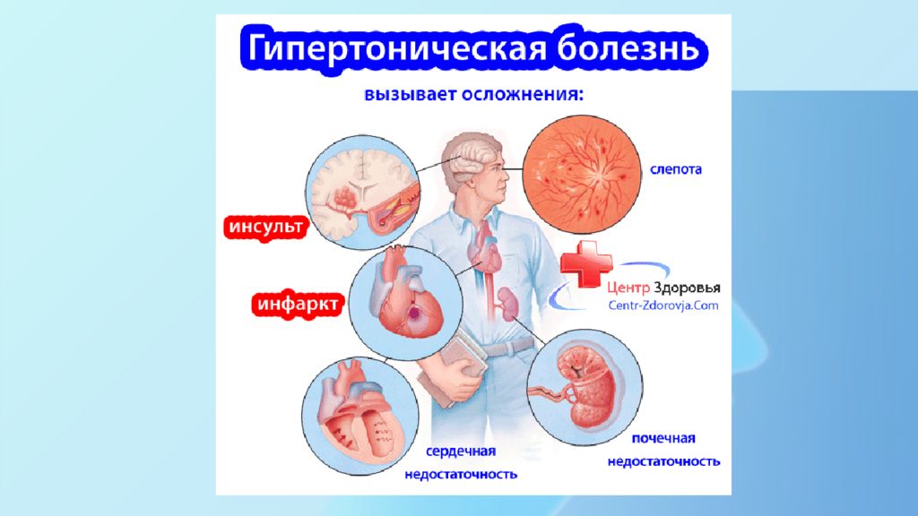 Схему гипертоническая болезнь