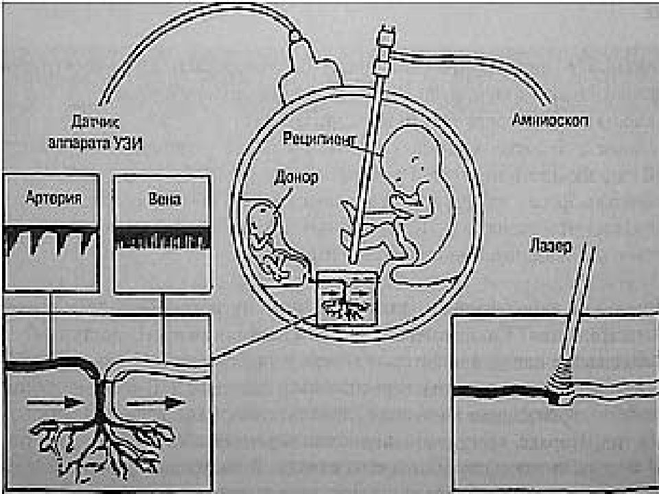 Фето фетальный трансфузионный синдром. Фетоскопическая коагуляция анастомозов плаценты. Фетоскопическая лазерная коагуляция сосудистых анастомозов. Лазерная коагуляция сосудистых анастомозов плаценты. Синдром фетальной гемотрансфузии.