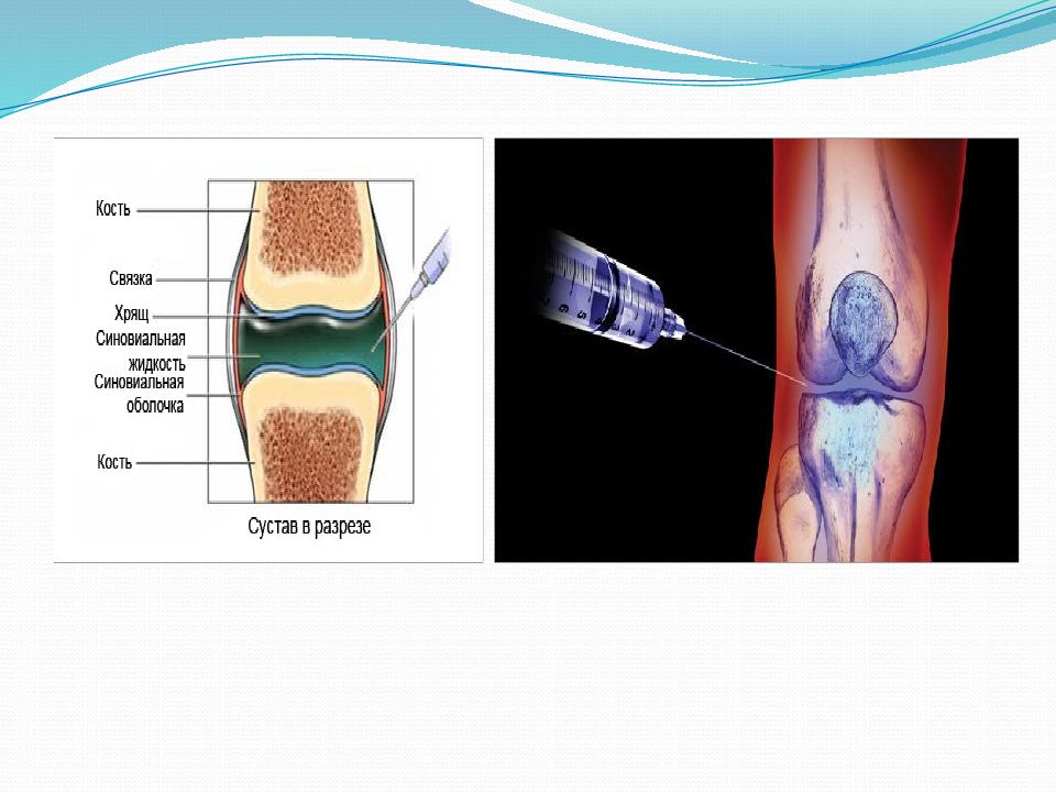 Суставная жидкость в суставе обеспечивает. Гной в синовиальной жидкости. Метель в синовиальной жидкости. Синовиальная жидкость муцин. Пирофосфат кальция в синовиальной жидкости.