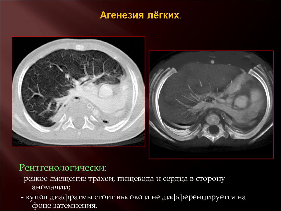 Агенезия венозного. Агенезия и аплазия легкого. Агенезия легких у детей.