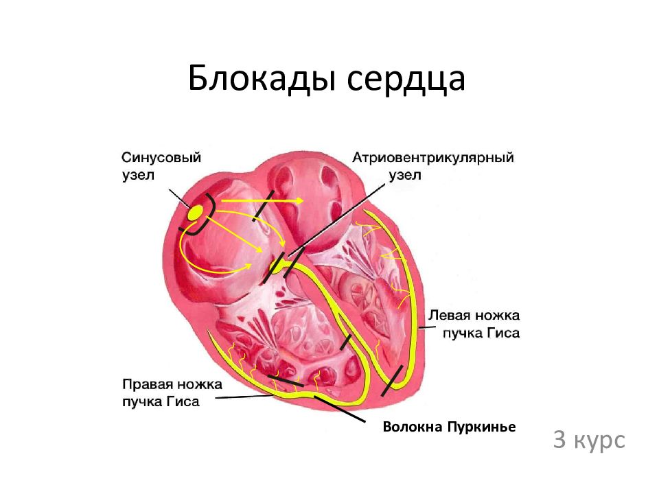 Блокада сердца что это простыми словами