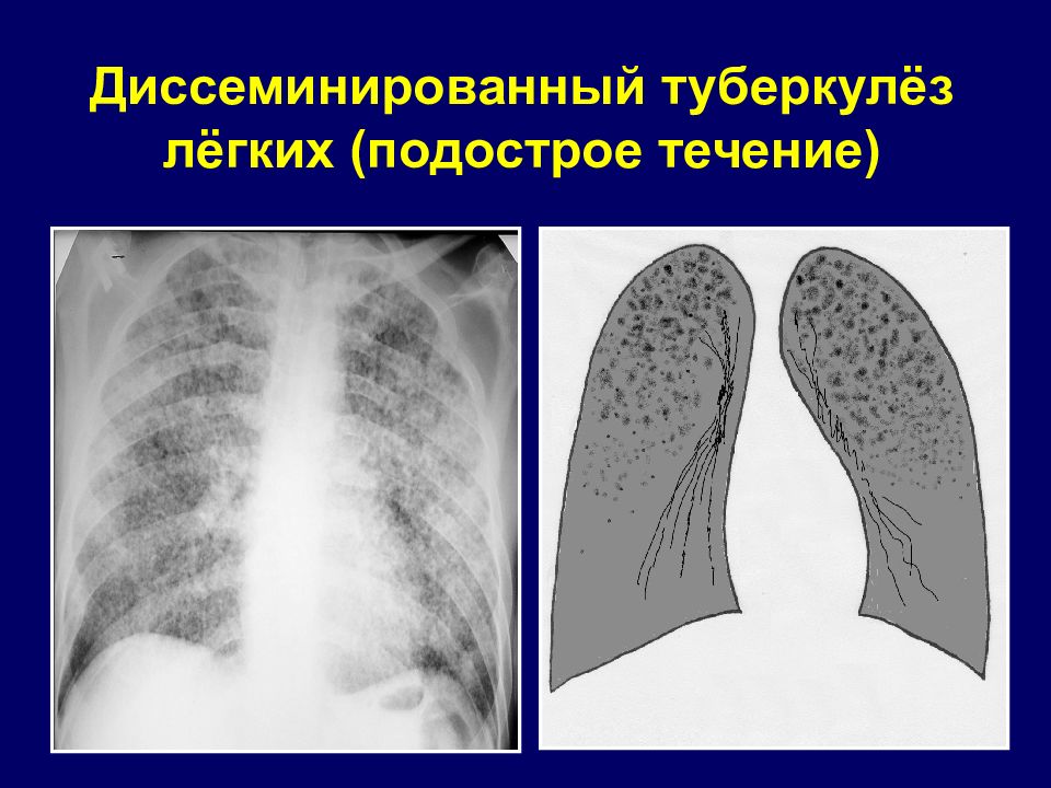 Диссеминированный туберкулез фаза инфильтрации. Хронический диссеминированный туберкулез рентген. Милиарный диссеминированный туберкулез рентген. Диссеминированный туберкулез легких рентгенограмма. Подострый диссеминированный туберкулез рентген.