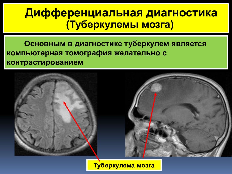 Туберкулез головного. Туберкулома головного мозга. Туберкулема головного мозга на кт. Туберкулема головного мозга мрт. Туберкулез мозговых оболочек.
