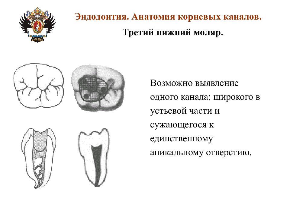 Анатомия каналов. Второй моляр нижней челюсти анатомия корневых каналов. Нижний 2 моляр корневые каналы. Анатомия корневых каналов нижних моляров нижней. Корневые каналы моляра нижней челюсти.