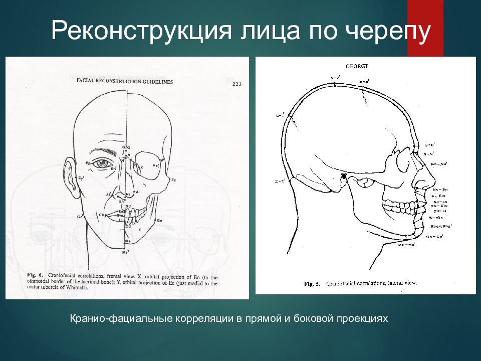 Орбитальной кости лица