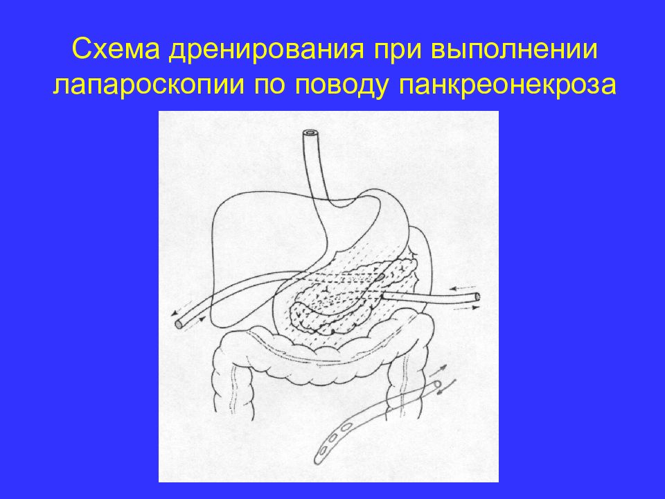 Панкреатит хирургия презентация