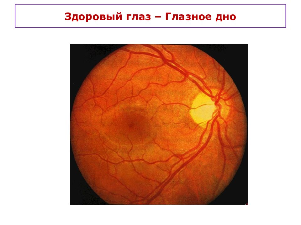 Глазное дно презентации