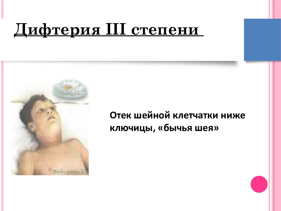 Дифтерия III степени