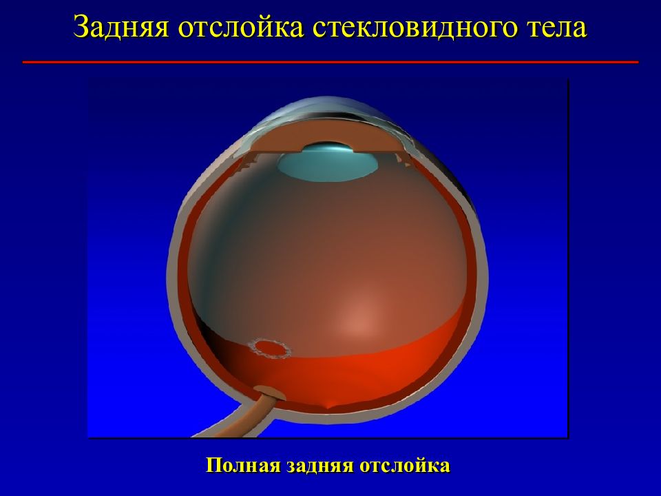 Лечение стекловидного тела. Отслойка стекловидного тела офтальмоскопия. Задняя отслойка стекловидного. Задняя стекловидного тела. Задняя отслойка стекловидного тела.