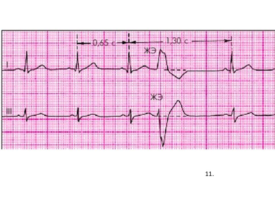 Замедление ав проводимости на экг. Супра венрикуларнатахикардия на ЭКГ.