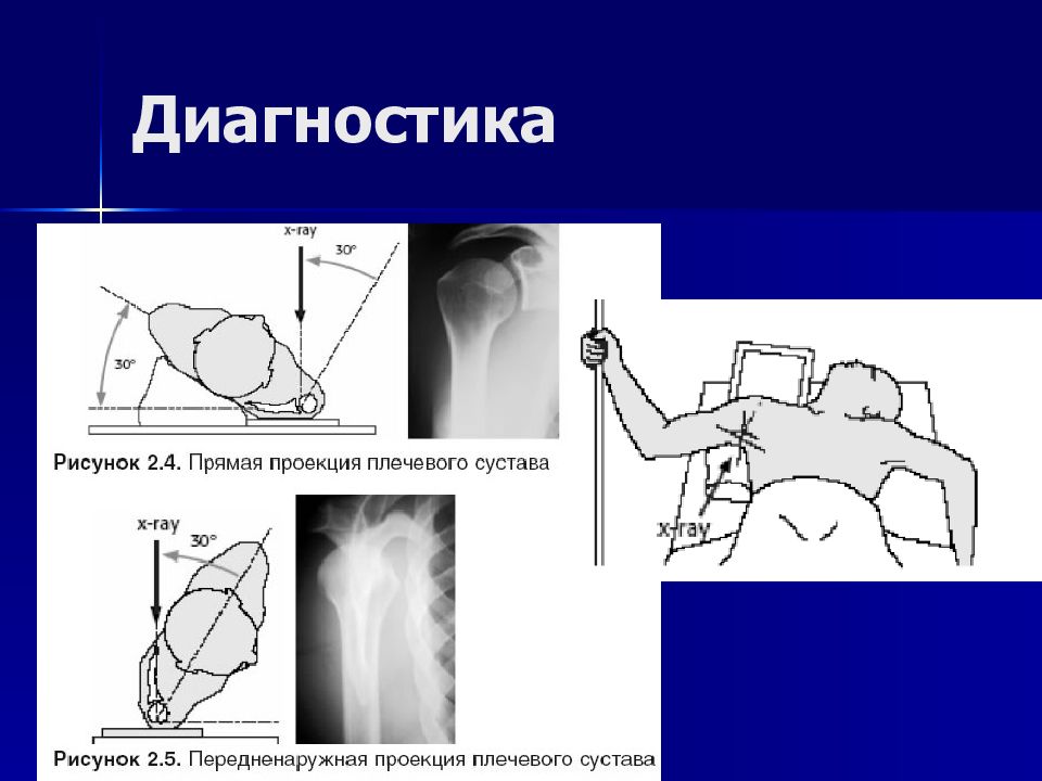 Диагностика 23. Плечевой сустав в боковой проекции рентген. Рентгенография плечевого сустава в 2 проекциях. Проекции плечевого сустава рентген. Плечевой суставрентген трансторокальная проекция.