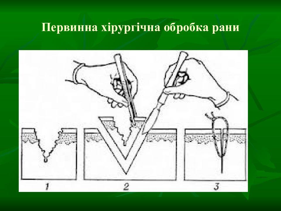 Проведение туалета раны