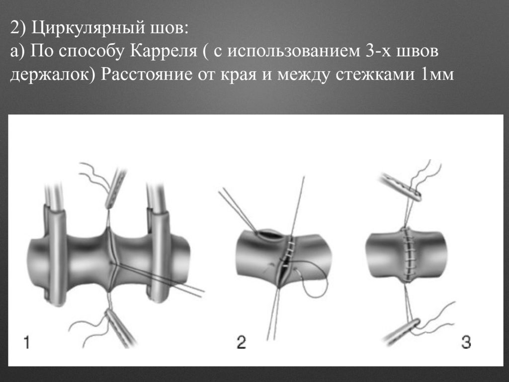 Швы шейках. Сосудистый шов шов по Каррелю. Алексис Каррель сосудистый шов. Сосудистый шов по Каррелю и Морозовой.