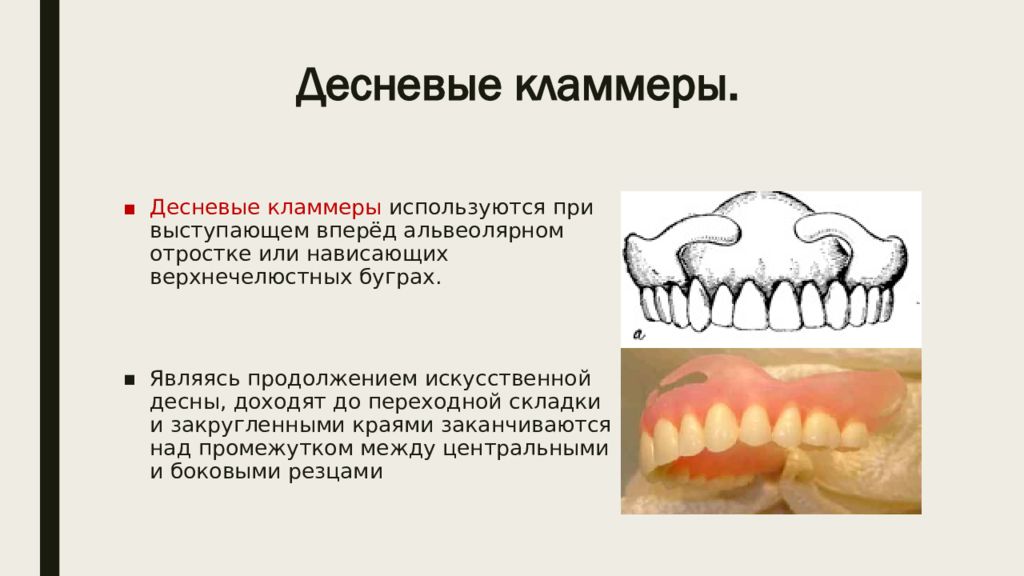 Методы фиксации полных съемных протезов