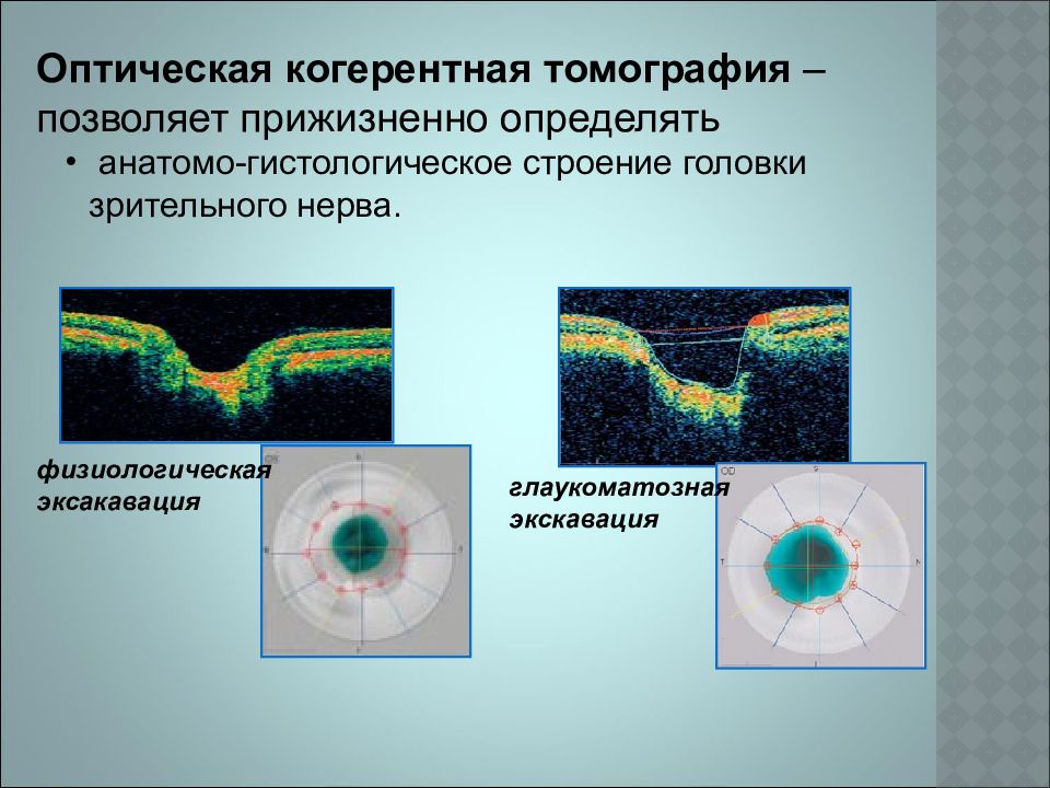 Когерентная томография. Оптическая когерентная томография норма и патология. Оптическая когерентная томография диска зрительного нерва. Оптическая когерентная томография макулярной области. Физиологическая и глаукоматозная экскавация.