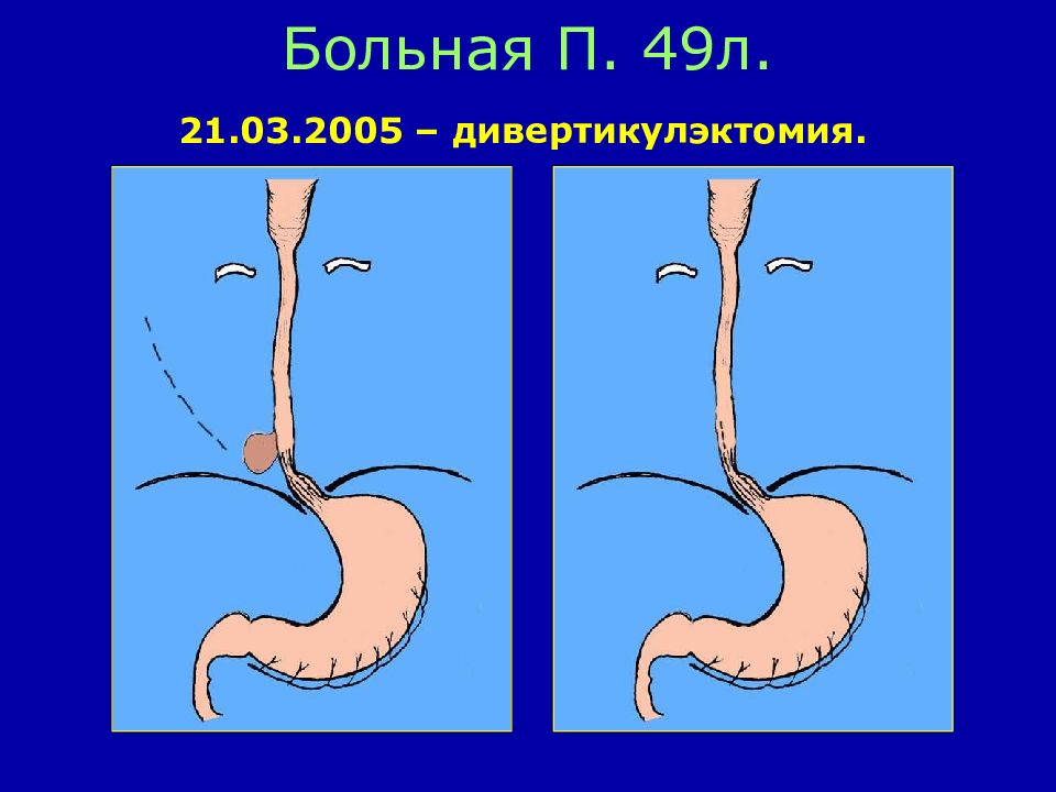 П болен. Доброкачественные заболевания пищевода. Ивашкин болезни пищевода.