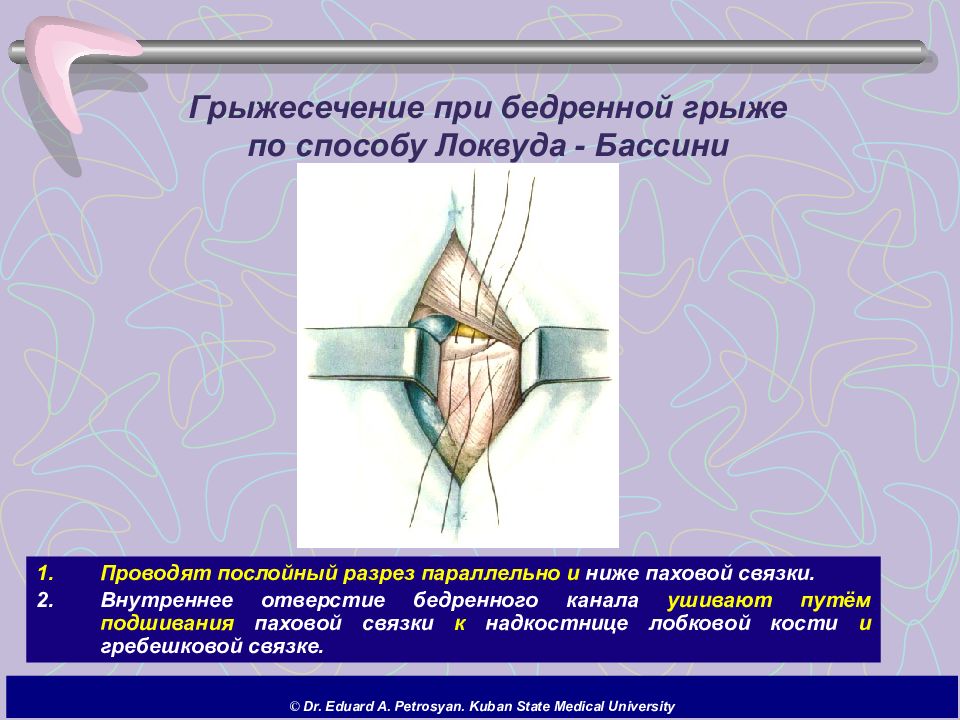 Бедренный способ. Бассини бедренная грыжа. Способ Бассини при бедренной грыже. Грыжесечение по по Бассини.