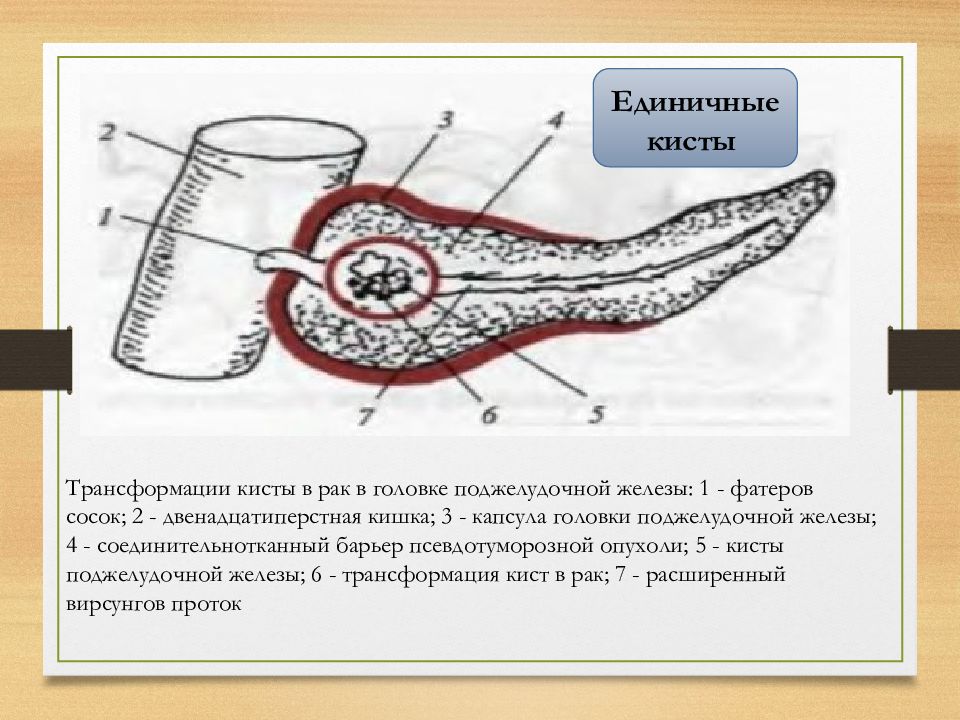 Кисты поджелудочной железы презентация