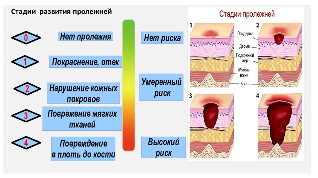 Размер пролежня