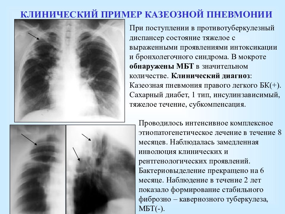 Для активного туберкулеза легких при умеренной интоксикации картина крови характеризуется