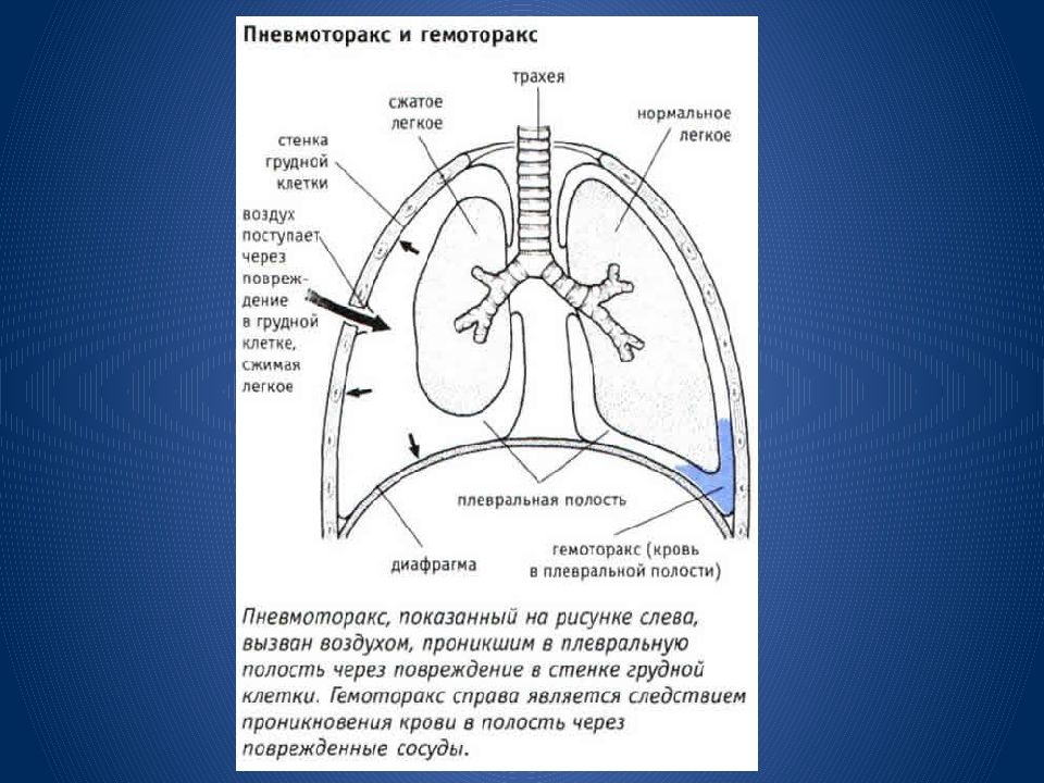 Презентация пневмоторакс и гемоторакс