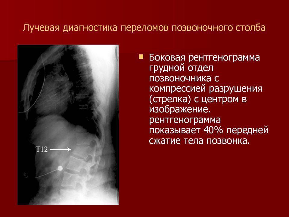 Диагноз перелом. Лучевая диагностика. Рентгенодиагностика переломов. Лучевая диагностика позвоночника. Лучевая диагностика переломов.