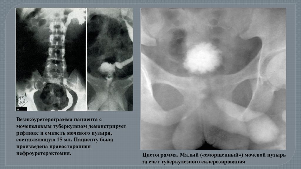 Туберкулез мочевой системы. Рентген при туберкулезе мочевого пузыря. Туберкулез простаты на УЗИ. Туберкулез мочевого пузыря кт. Цистография патология мочевого пузыря.