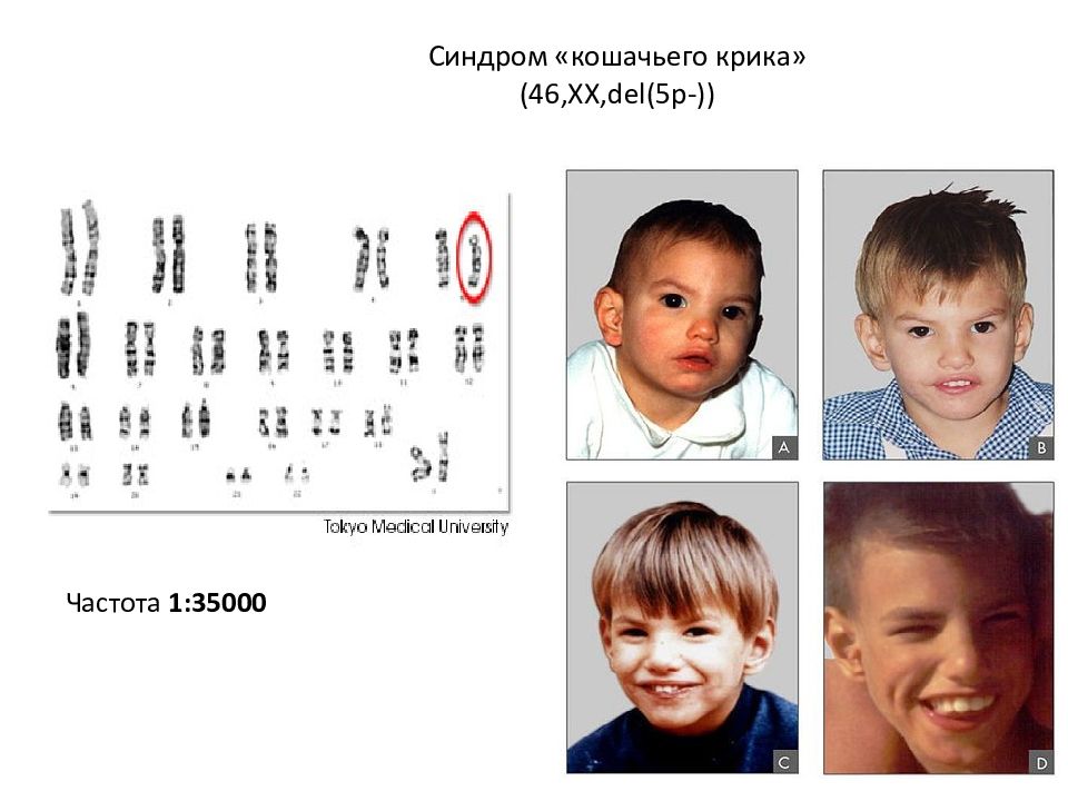 Презентация на тему синдром кошачьего крика