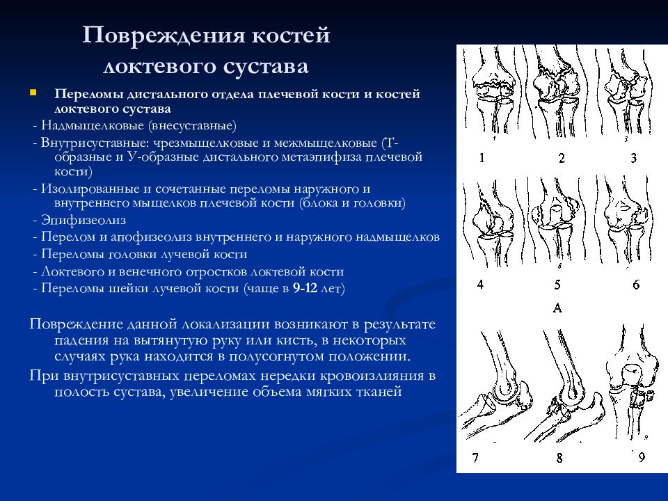 Переломы плечевой кости травматология презентация