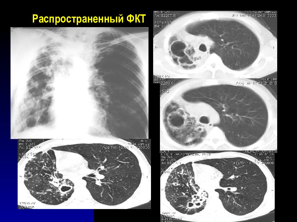 Лучевая диагностика органов дыхания презентация