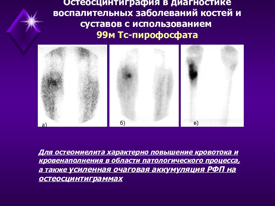 Диагностика костей. Сцинтиграфия остеомиелит. Остеомиелит на сцинтиграфии. Радионуклидное сканирование костей при остеомиелите. Сцинтиграфия при остеомиелите.