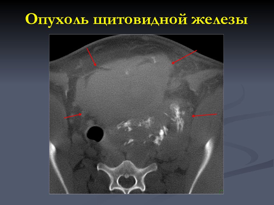 Злокачественные опухоли щитовидной железы презентация