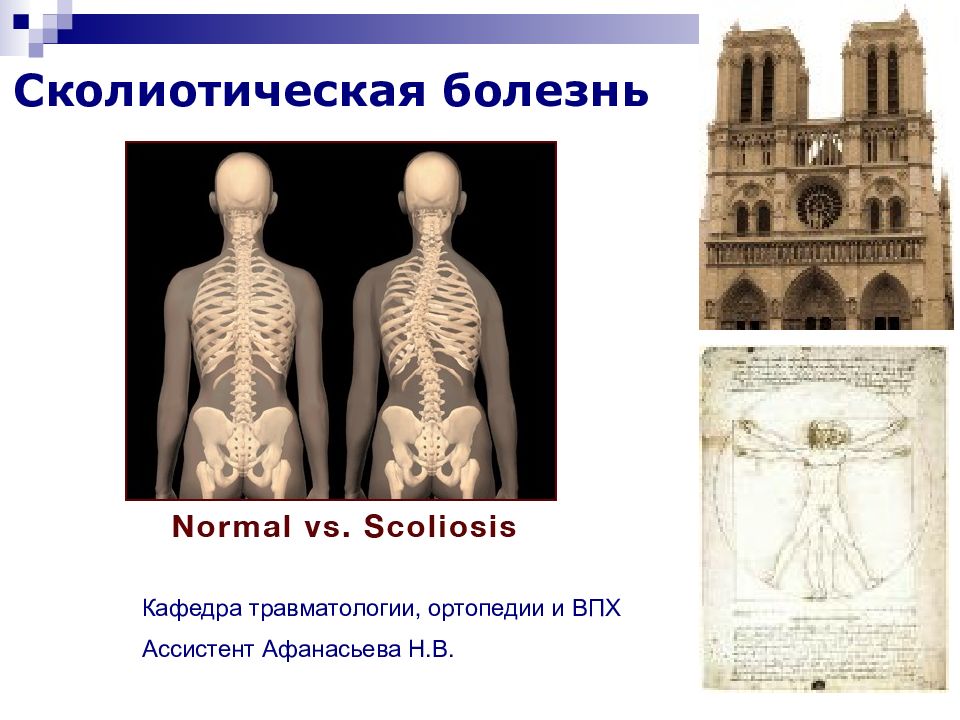 Сколиоз позвоночника презентация травматология