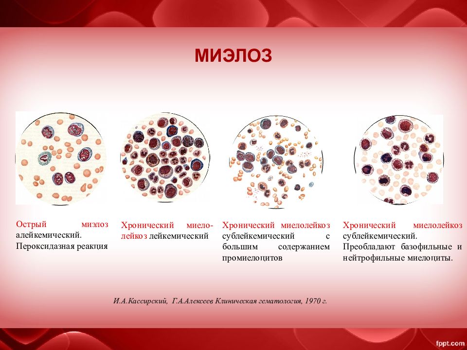 Хронический лейкоз рекомендации. Миелоциты хронический миелолейкоз. Хронический миелолейкоз и острый миелобластный лейкоз. АЛЕЙКЕМИЧЕСКИЙ острый лейкоз. Острый базофильный лейкоз.
