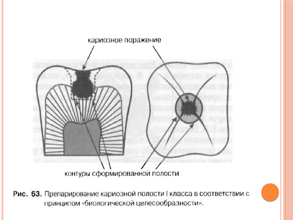 Края кариозной полости. Принцип ящикообразности кариозной полости. Основные элементы кариозной полости. Элементы сформированной кариозной полости. Препарирование кариозных полостей.