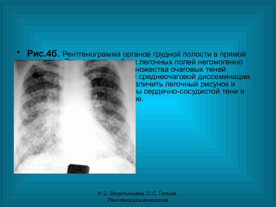 Легочный рисунок диффузно усилен с обеих сторон