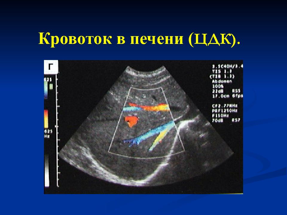 Цдк 6. Цветное допплеровское картирование (ЦДК). Кровоток на УЗИ. УЗИ печени ЦДК. Дуплексное картирование это цветное.