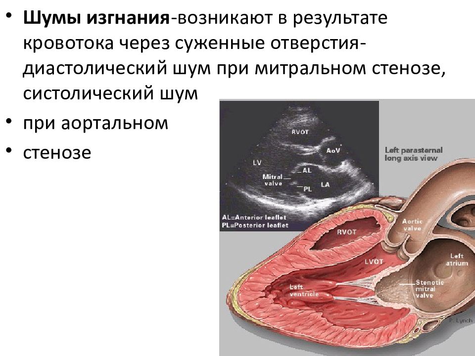 Систолической регургитацией. Шум изгнания. Шум изгнания возникает при следующем пороке сердца:. Шум изгнания и шум регургитации. Шумы изгнания и регургитации.