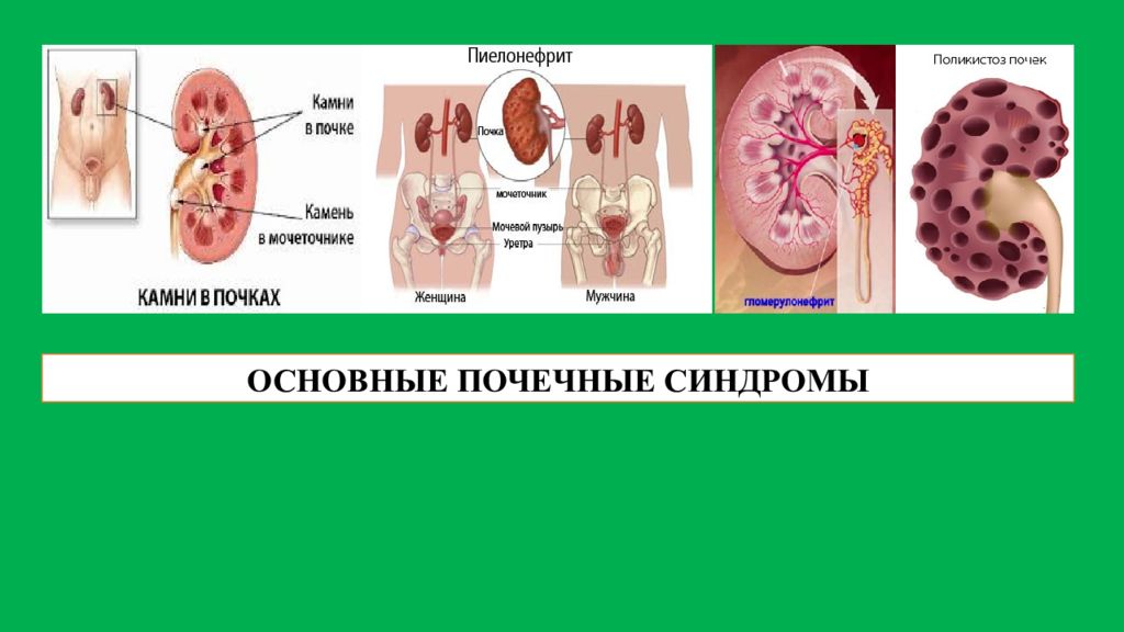 ОСНОВНЫЕ ПОЧЕЧНЫЕ СИНДРОМЫ