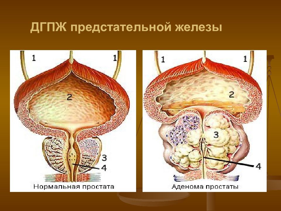 Аденома предстательной железы карта вызова скорой медицинской