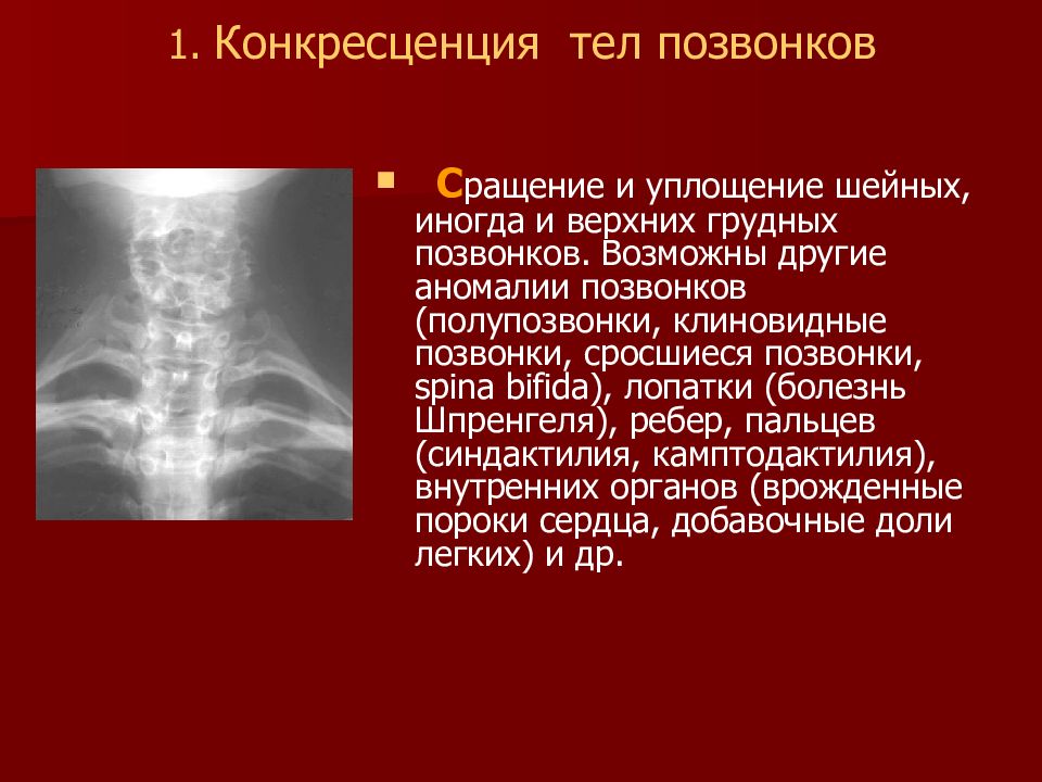 Сросшиеся позвонки. Конкресценция с1 с2 рентген. Конкресценция шейных позвонков рентген. Частичная конкресценция тел позвонков с5/с6. Конкресценция остистых отростков с2-с3.