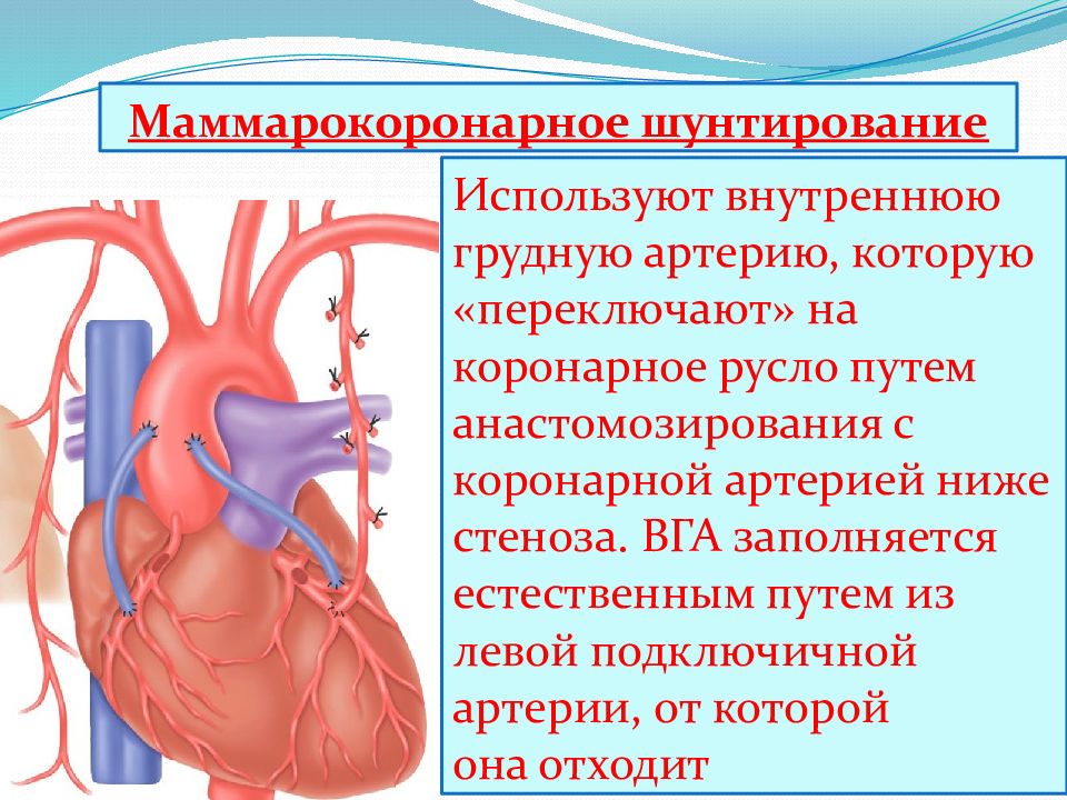 Шунтирование сердца что это такое простыми словами. Маммарокоронарное шунтирование. Маммарокоронарное шунтирование показания. Колесов маммарокоронарное шунтирование.