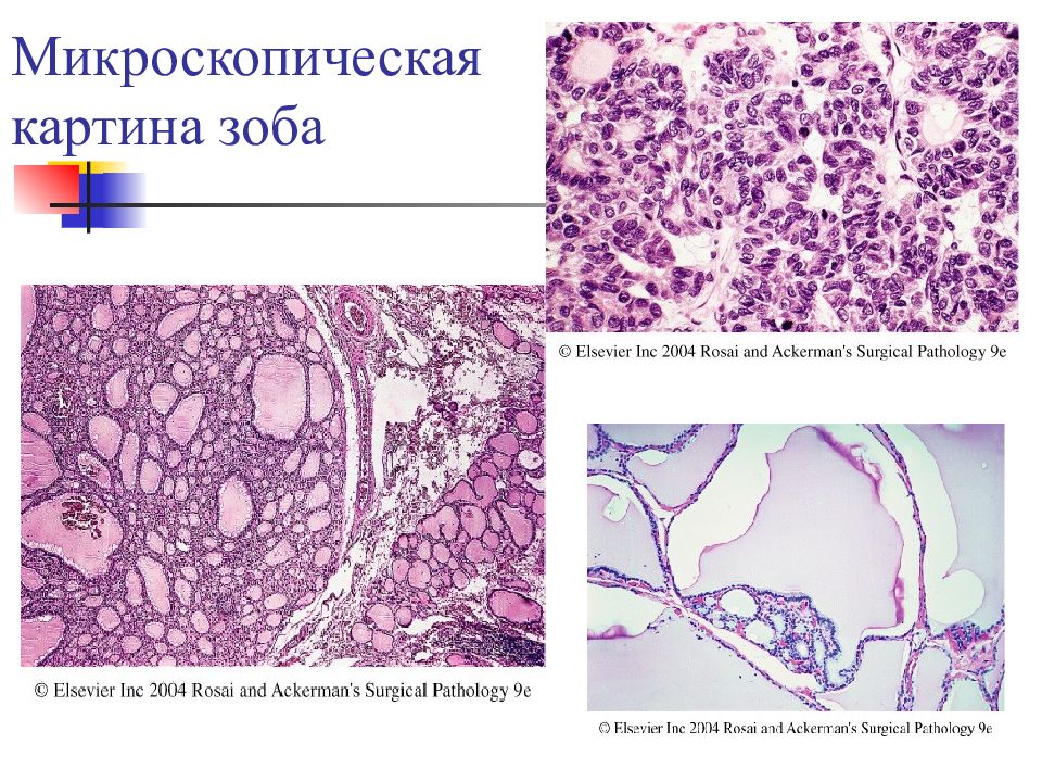 Железы 10. Микроскопическая картина. Патоморфология заболеваний щитовидной железы. Микроскопически различают зоб. Микроскопическая картина органов.