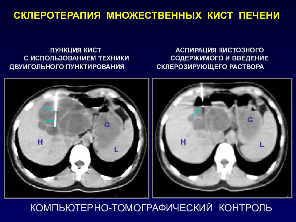 Непаразитарные кисты печени презентация