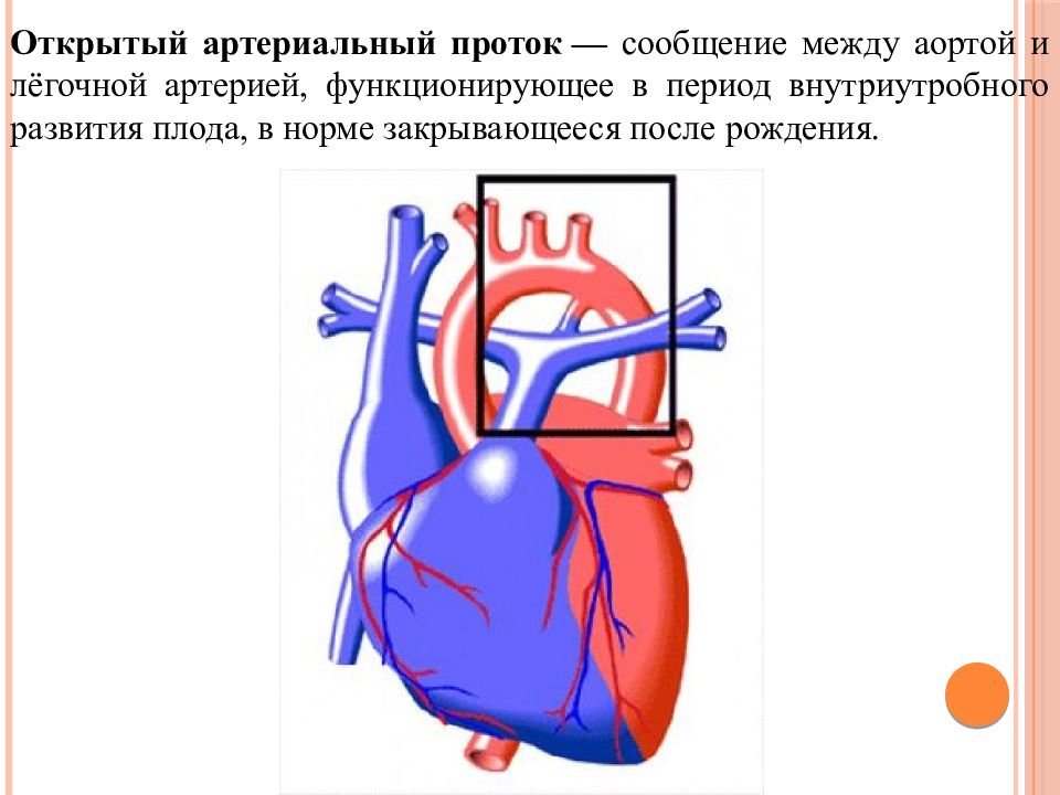 Открытый артериальный проток схема