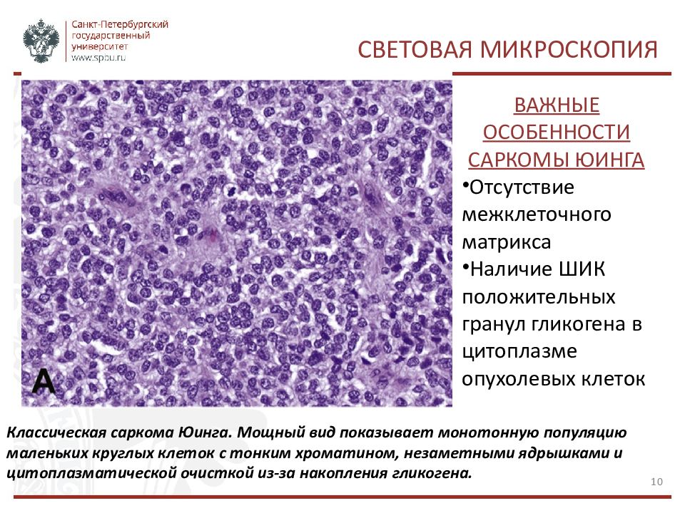 Саркома юинга презентация