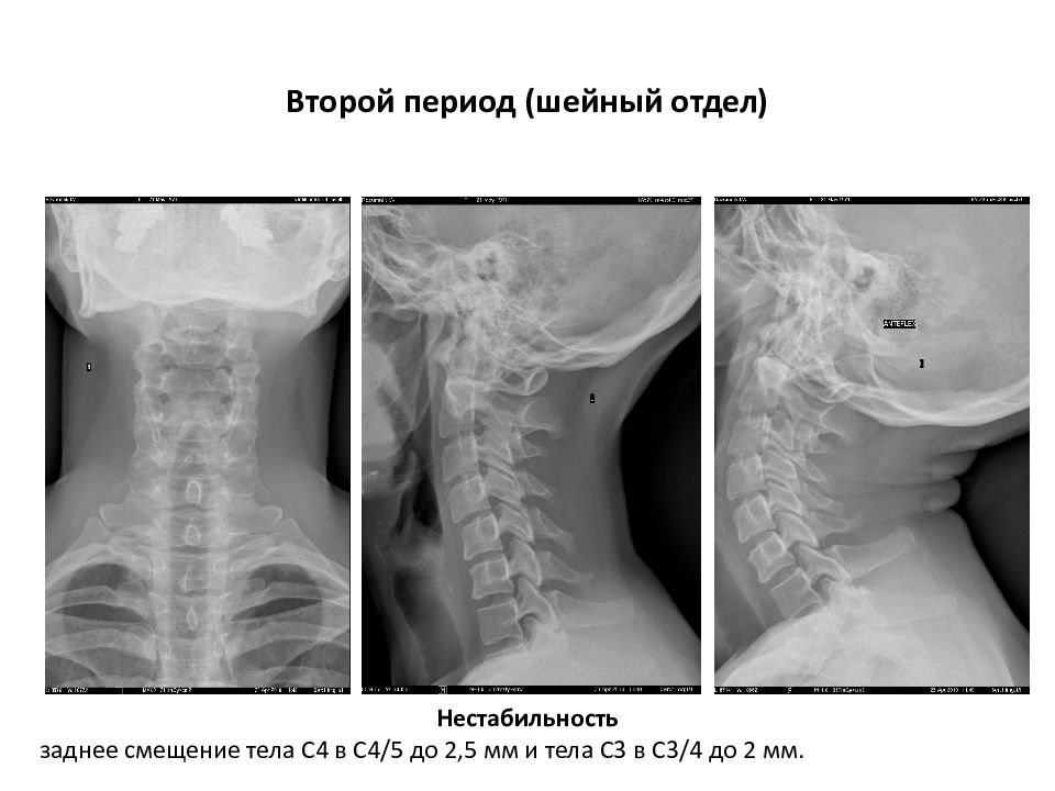 Эхографическая картина нестабильности в сегменте с2 с3