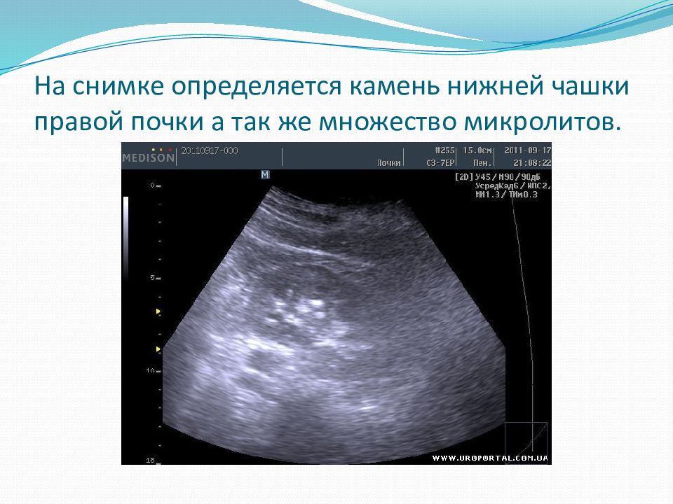 Микролиты в почках что это такое. Микролиты в почках на УЗИ. Чашечки почки на УЗИ. Расширение чашечек почки на УЗИ. Конкремент в чашечке почки на УЗИ.