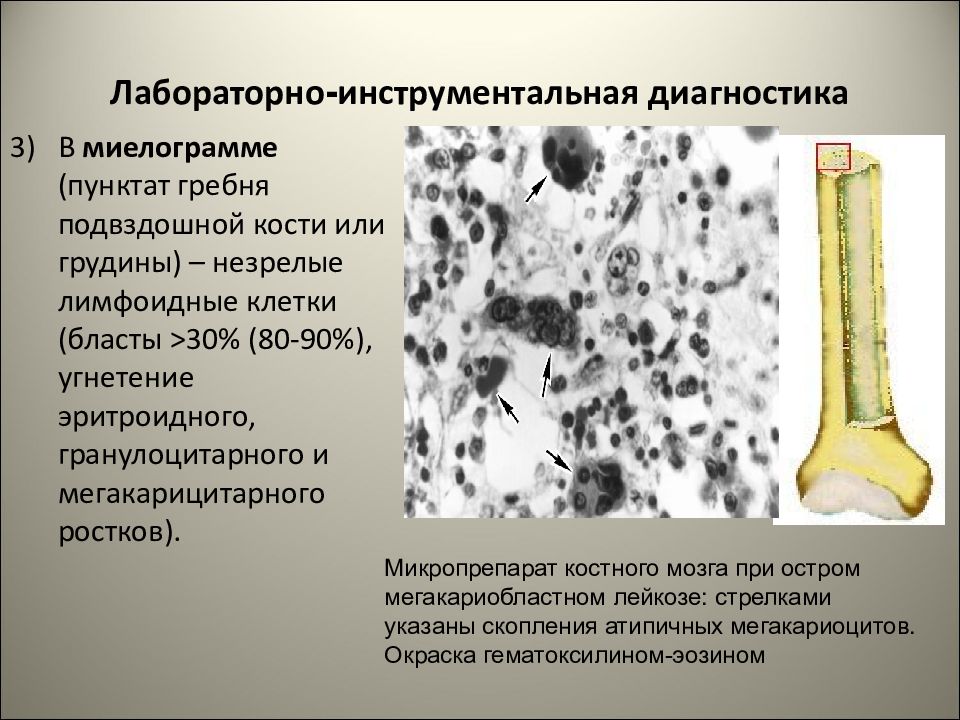 Пиоидный костный мозг. Костный мозг при остром лейкозе макропрепарат. Костный мозг при остром лейкозе макропрепарат описание. Костный мозг при лейкозе макропрепарат. Лейкоз костного мозга макропрепарат.