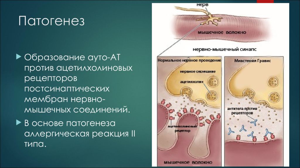 Патогенез нервных болезней. Миастения Гравис этиология. Миастения Гравис патогенез. Миастения этиология патогенез. Миастения это аутоиммунное заболевание.